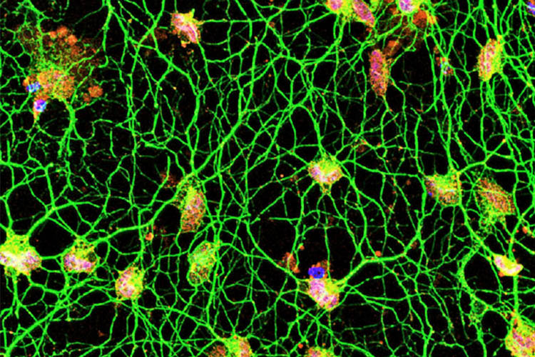 Para ilmuwan telah menemukan cara baru untuk mengubah sel kulit manusia secara langsung menjadi neuron motorik